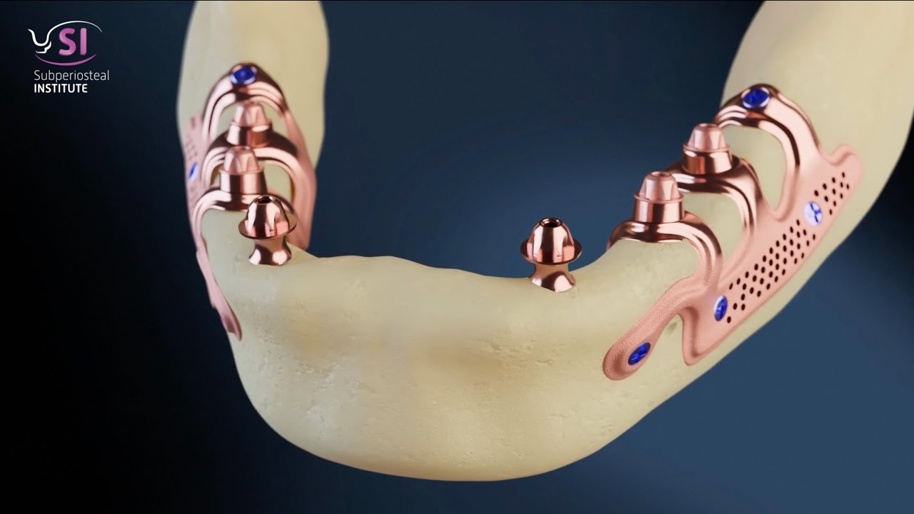 Complete mandibular edentulism treated with two subperiosteal implants and two cylindrical implants