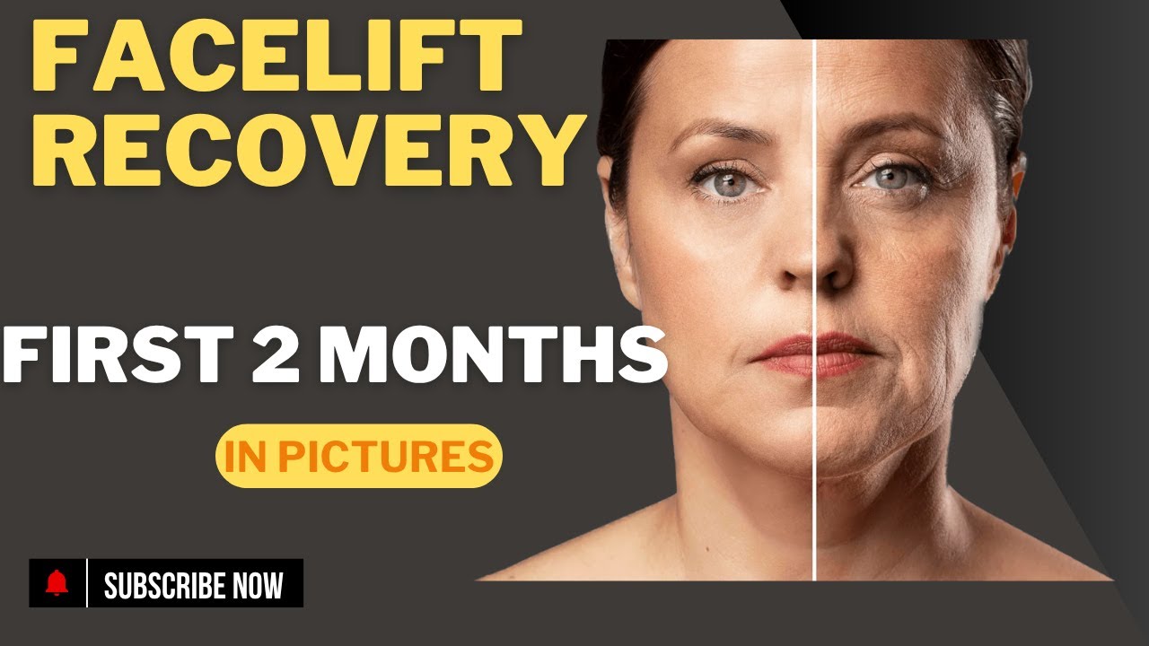 The first two months of facelift recovery in pictures.