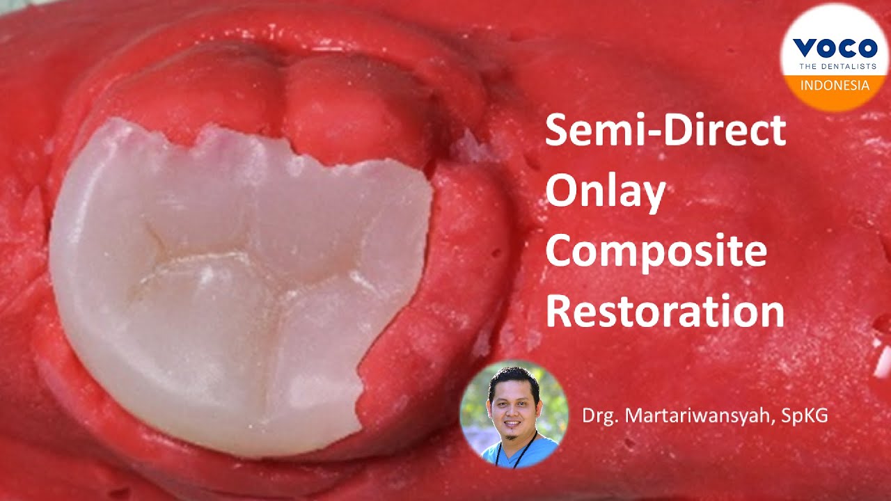 Semi-direct Restoration Chairside Composite Onlay | Die Silicone VOCO