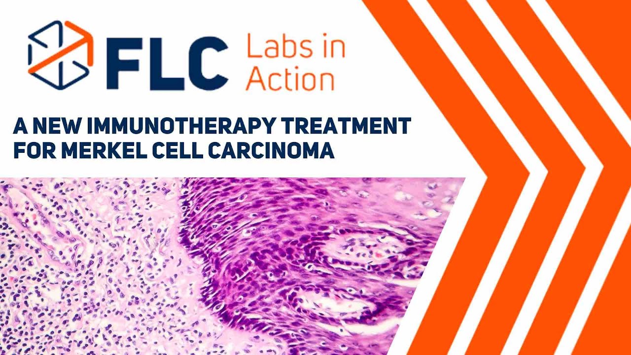 Labs In Action: A New immunotherapy Treatment for Merkel Cell Carcinoma