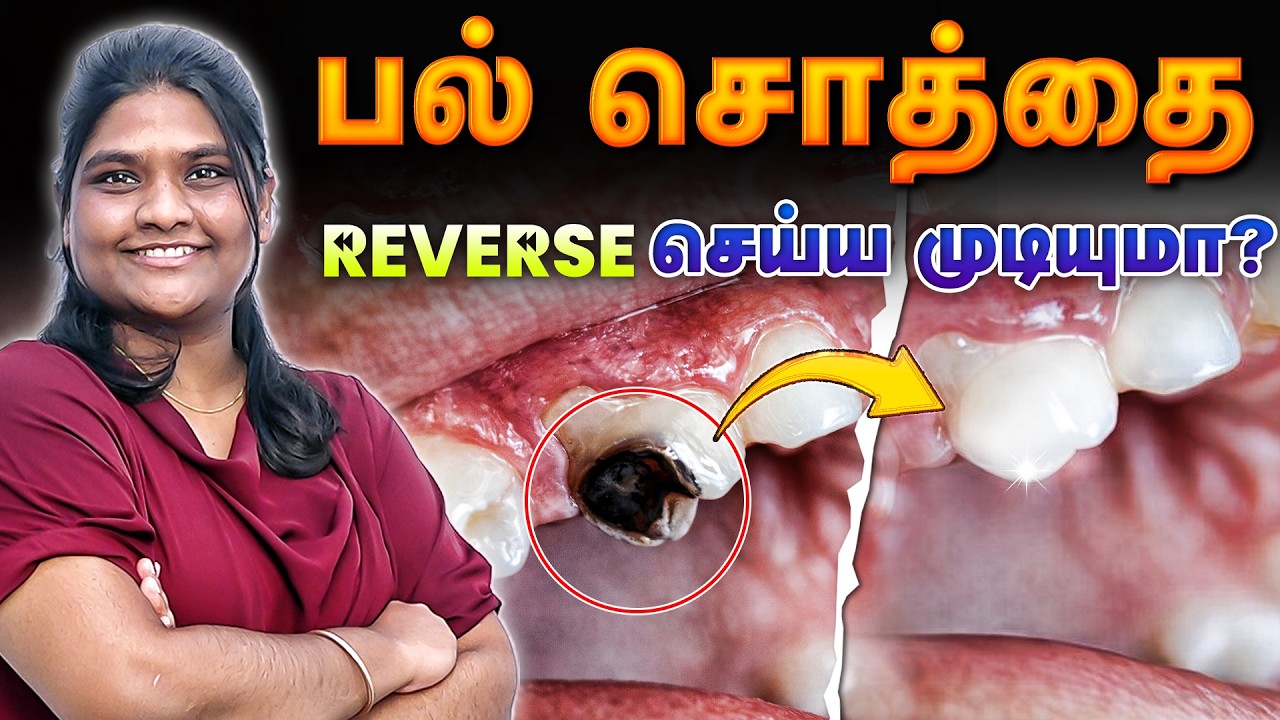 பல் சொத்தை REVERSE செய்ய முடியுமா ? Dentist explains | Universe Dental Care