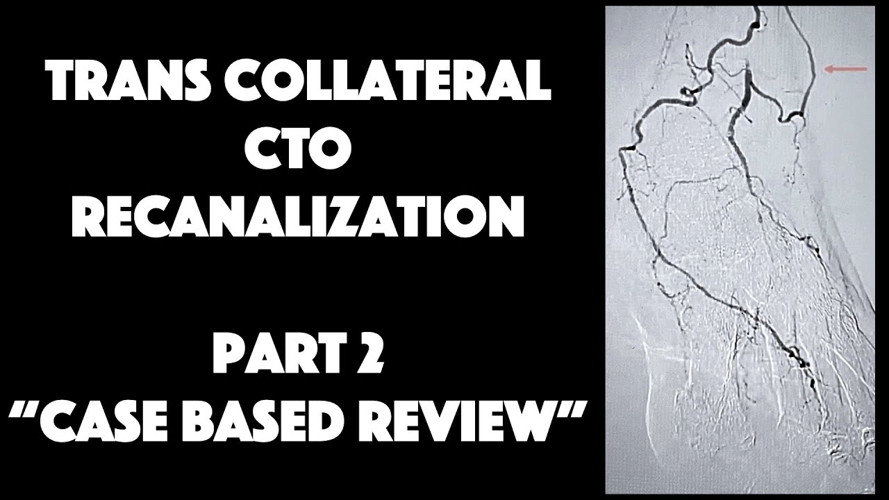 Part 2 Trans-Collateral CTO Recanalization (Advanced)