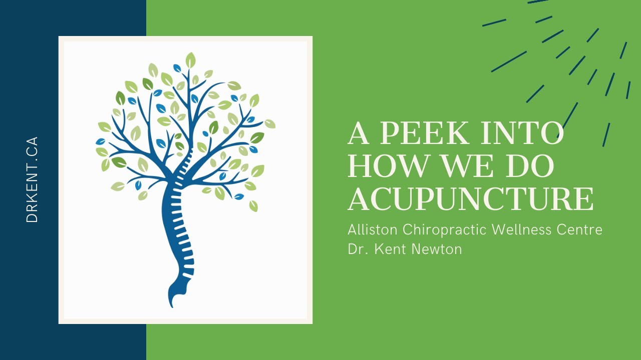 Acupuncture for Muscle Spasm | Alliston Chiropractor | Dr. Kent Newton