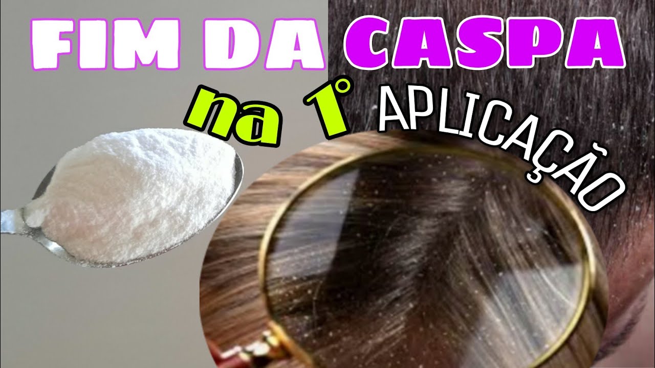 MELHOR REMEDIO CASEIRO PRA ACABAR DE VEZ COM A CASPA | end of dandruff