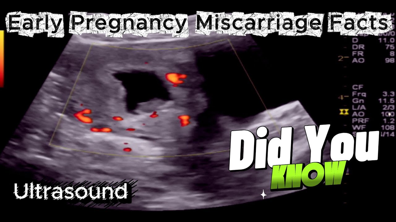 Early Pregnancy Miscarriage - Facts