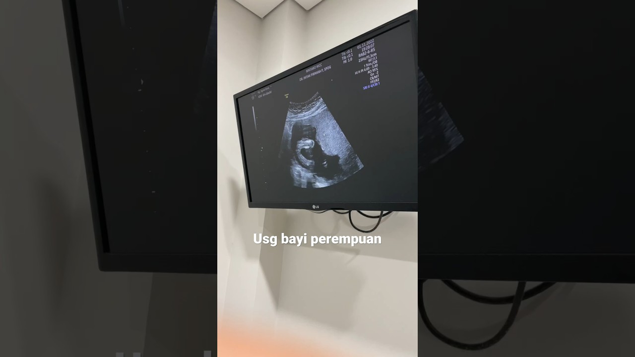 USG Bayi perempuan #usg #usgbayiperempuan #usg4dimensi #kehamilan