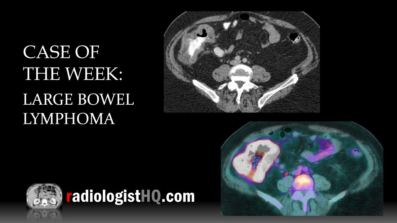Case of the Week:  Large Bowel Lymphoma (CT & PET)