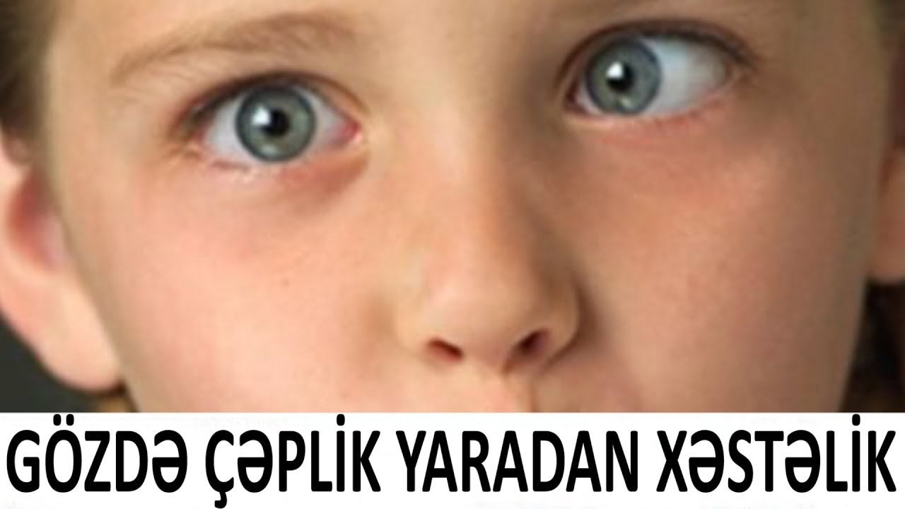 Bu xəstəlik g&ouml;zdə &ccedil;əplik yaradır - Hipermetropiya nədir?