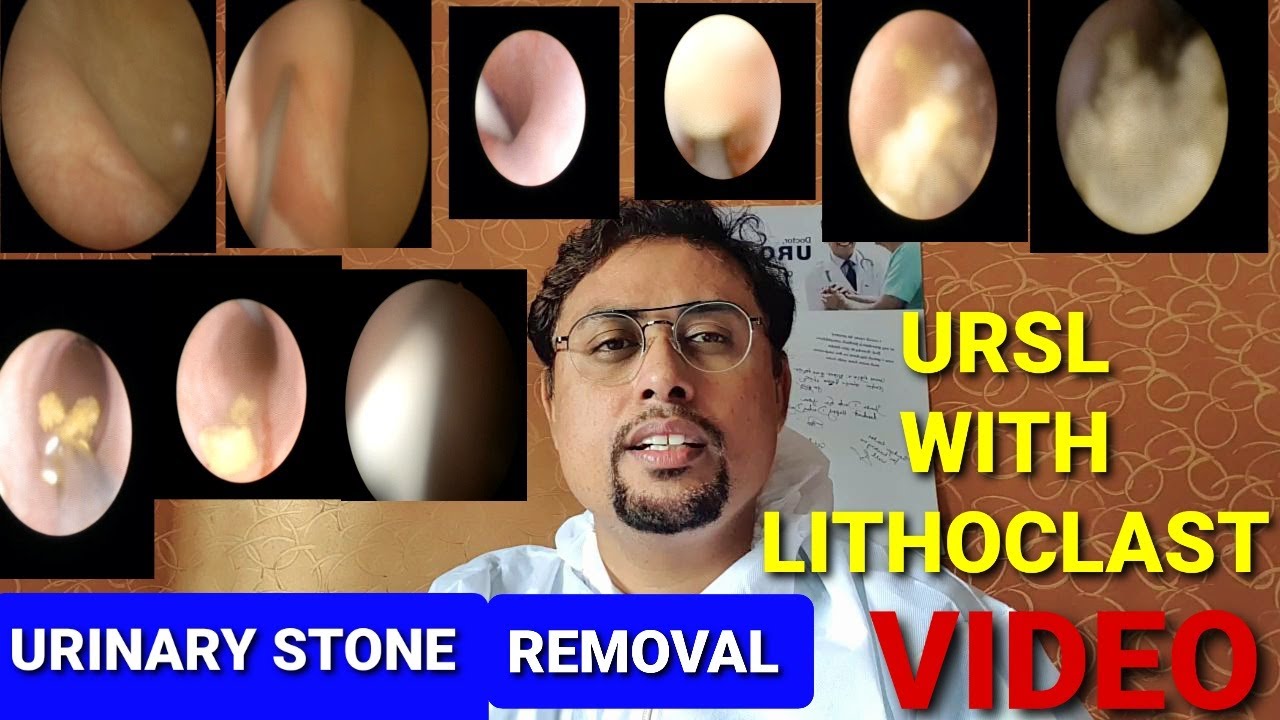 URSL Surgery | Ureteroscopy Removal Of Ureteric Stone Lithoclast यूरेटरिक स्टोन Surgical Procedure