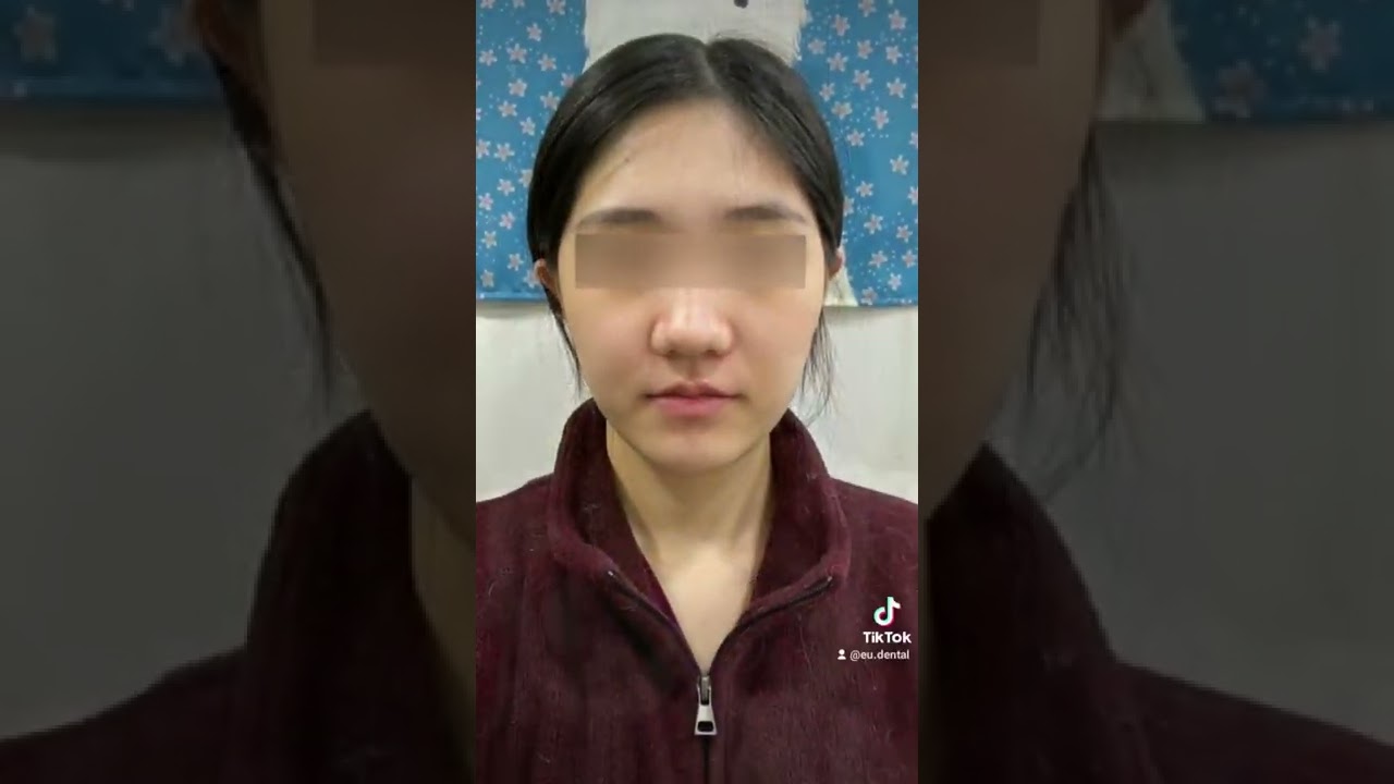 Korean Cheekbone Reduction Surgery Results | (Before & After) #shorts