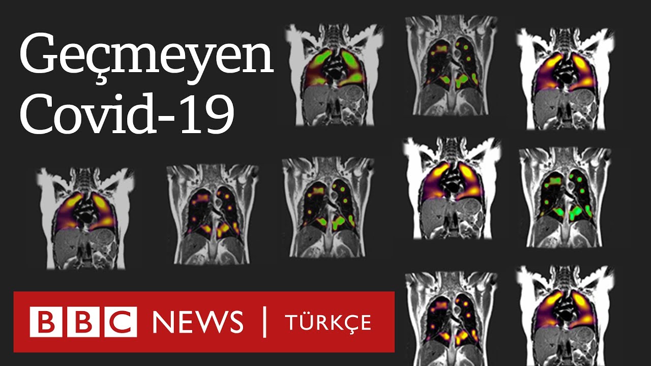'Uzatmalı Covid-19' muamması: Bazı insanlarda hastalık neden uzun sürüyor?