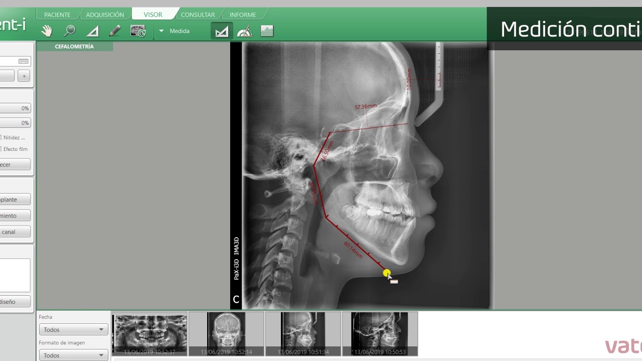 EzDent-i / Calibración y Medición de imagen