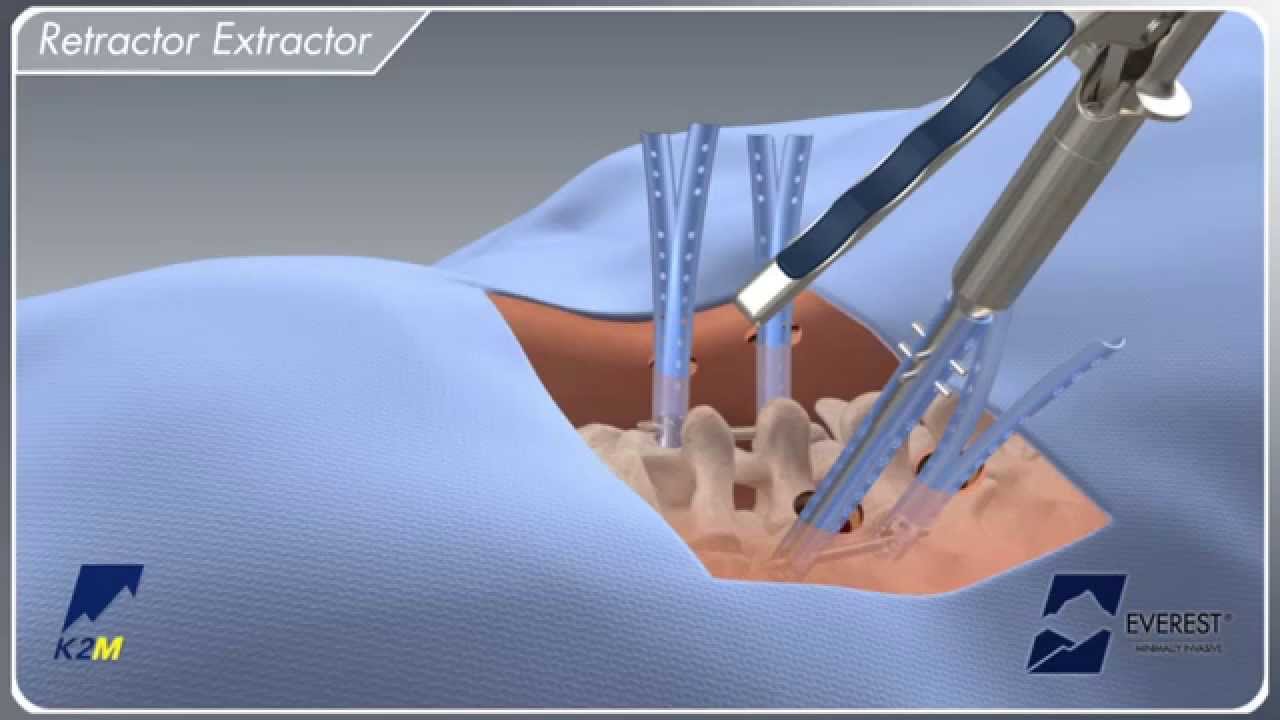EVEREST&reg; Minimally Invasive Surgical Technique Animation