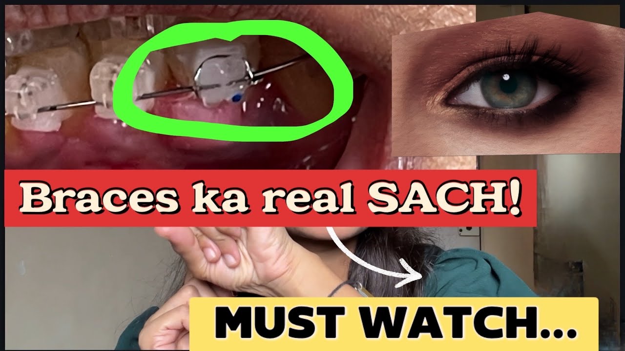 Braces Reality They Never Tell You 😬💥 | What To Know Before Getting Braces! #BracesJourney #RealTalk