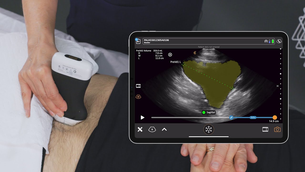 Clarius Bladder AI with the PAL Scanner