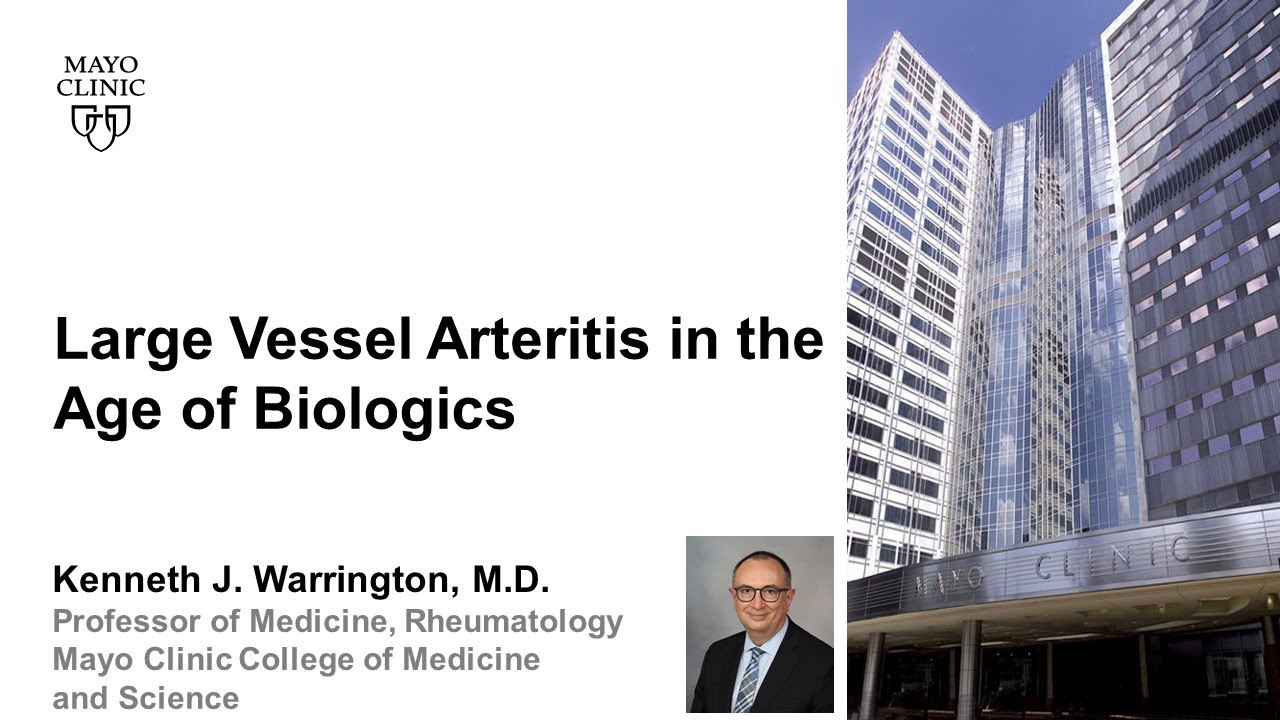 Large Vessel Arteritis in the Age of Biologics