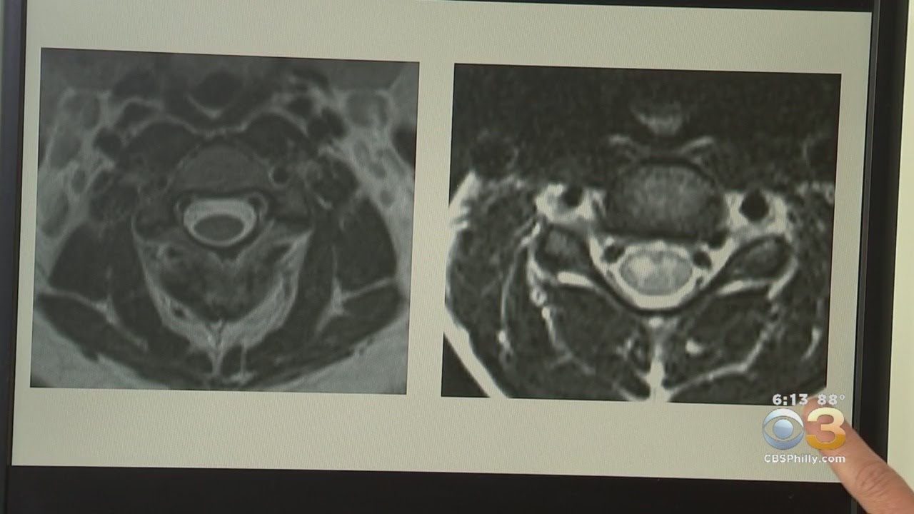 Mysterious Condition That Causes Polio-Like Symptoms In Kids Arrives Early In Pennsylvania