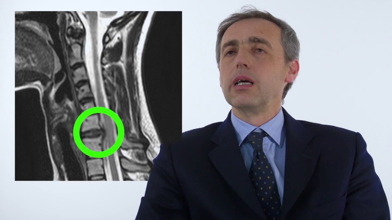 Dr. Fabio Tresoldi - Ernia Discale Cervicale
