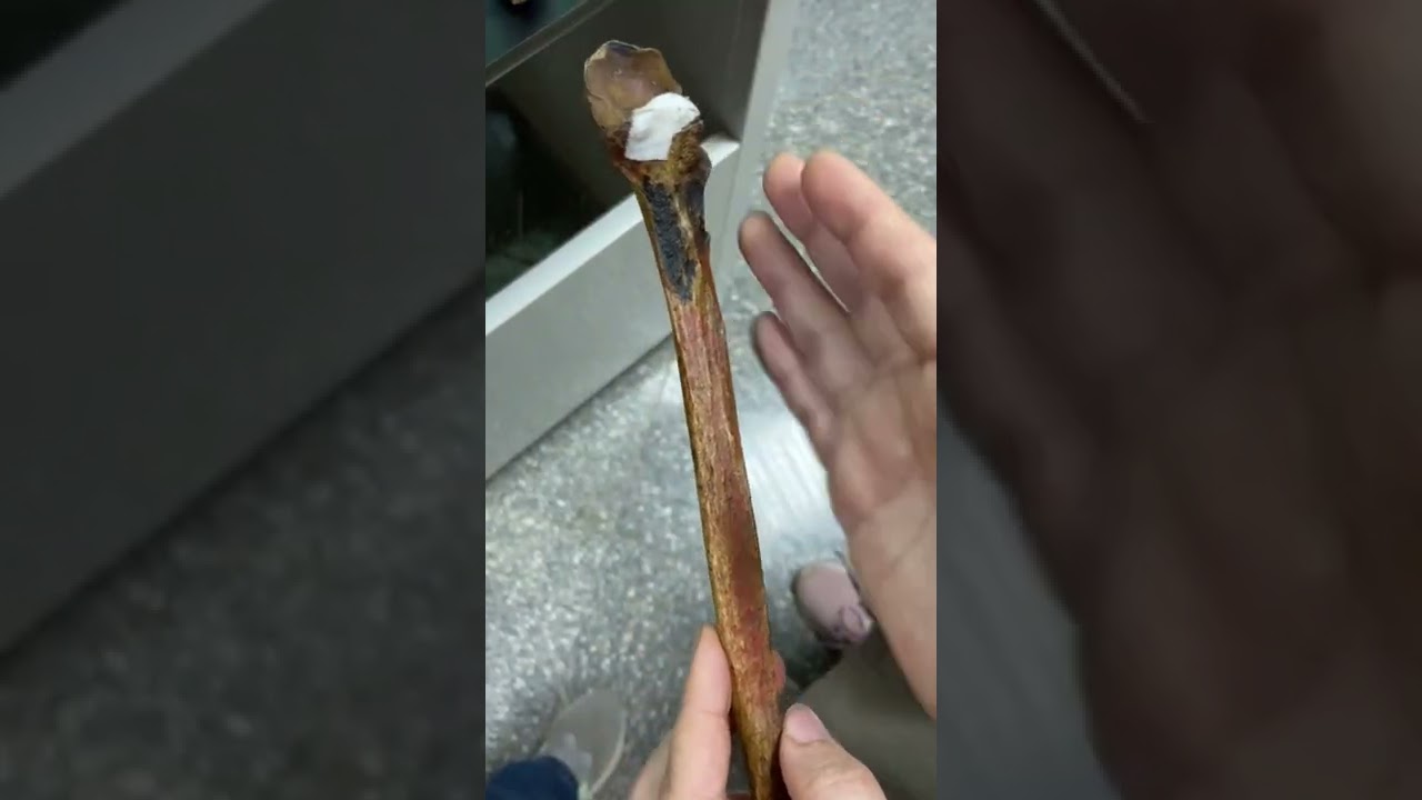 Upper limb bones ( ulna )