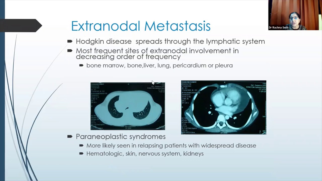 Systemic Treatment in Pediatric Hodgkin Lymphoma & NHL _Prof Rachna Seth