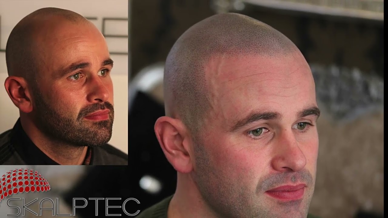 Skalptec/ Amazing Scalp Micropigment results from 2021