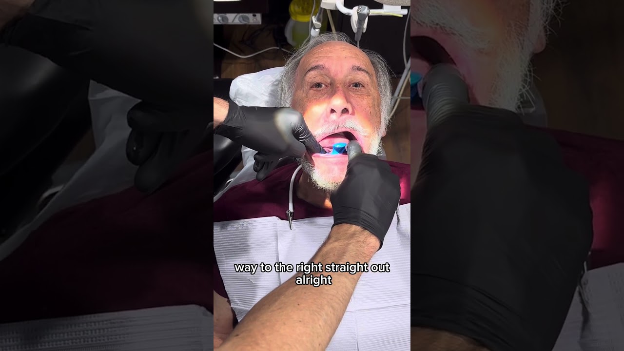 Lower Wagner Tray Impression for a Lower Digital Denture