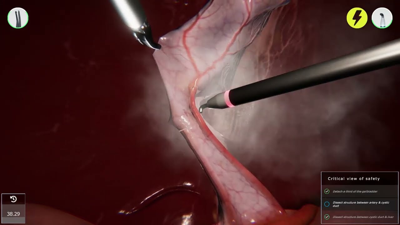 👩🏽&zwj;⚕️LAPAROSCOPIC CHOLECYSTECTOMY / Gallbladder removal / 3D simulation