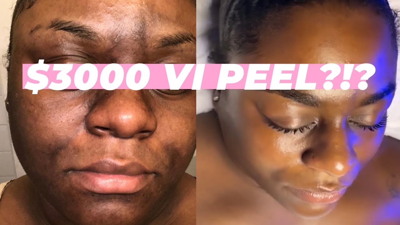DRAMATIC VI Peel Before and After for Melasma