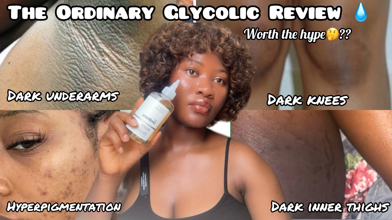 The Ordinary Glycolic Acid Toner Review | My Honest Experience  #glycolicacid #skincare 