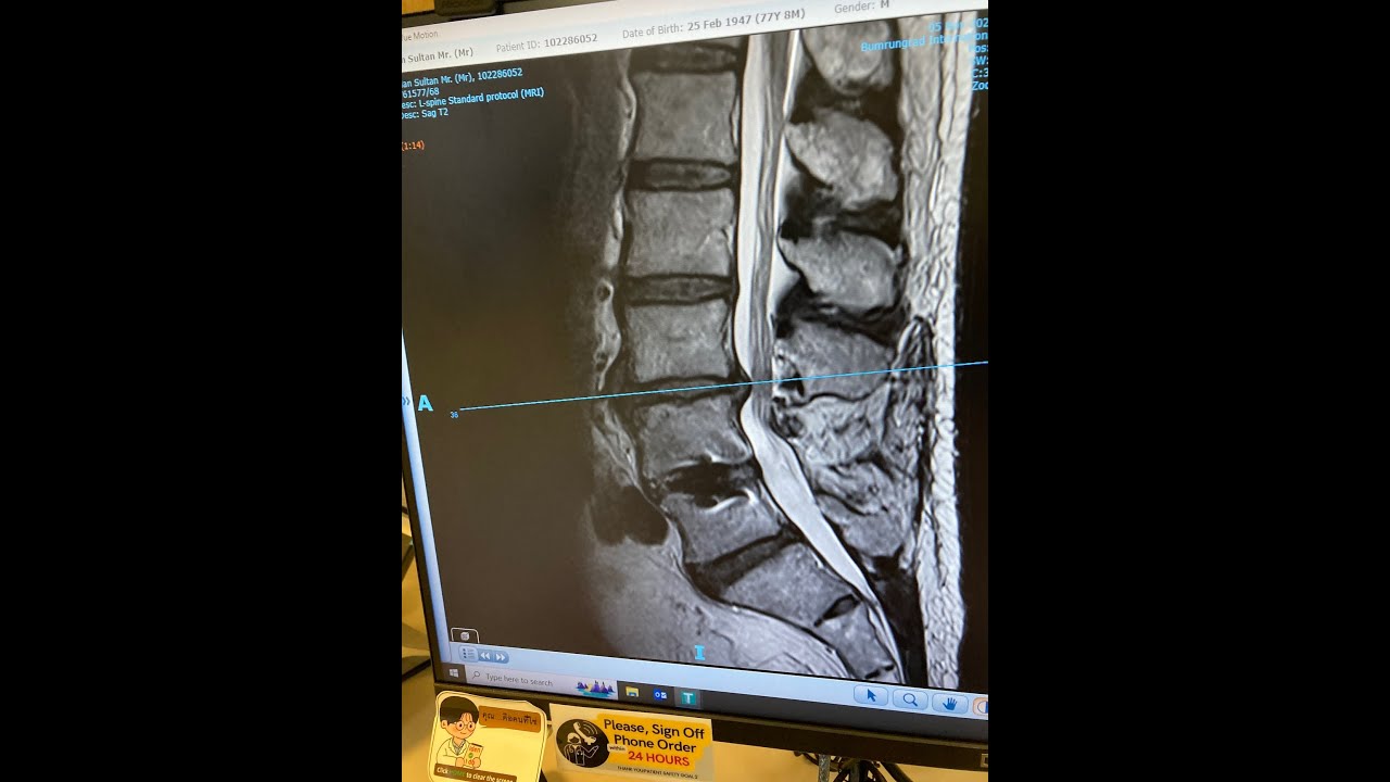 Outcome of Spine Surgery in Bangkok