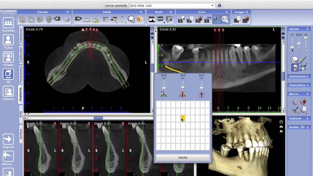 5  Tutorial de Planificación de implante mandibular Romexis