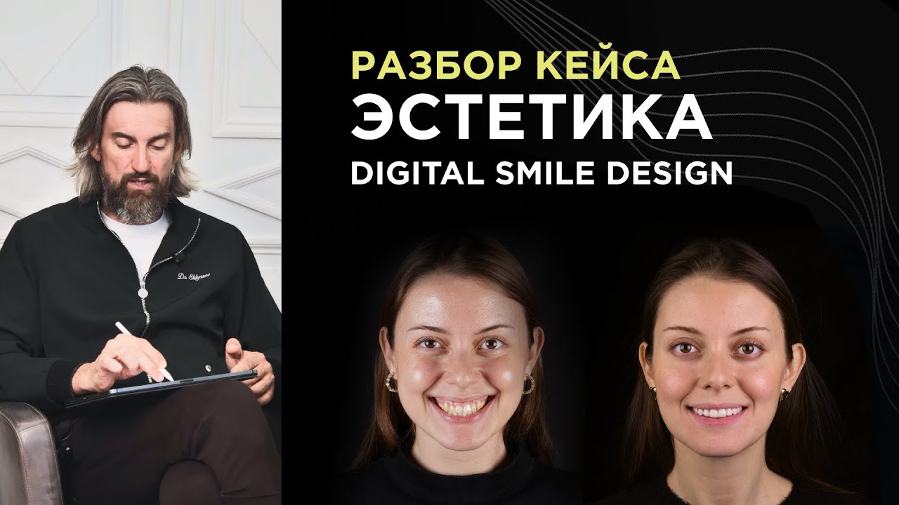 Как планировать эстетический кейс с десневой улыбкой? Разбор с использованием Digital Smile Design