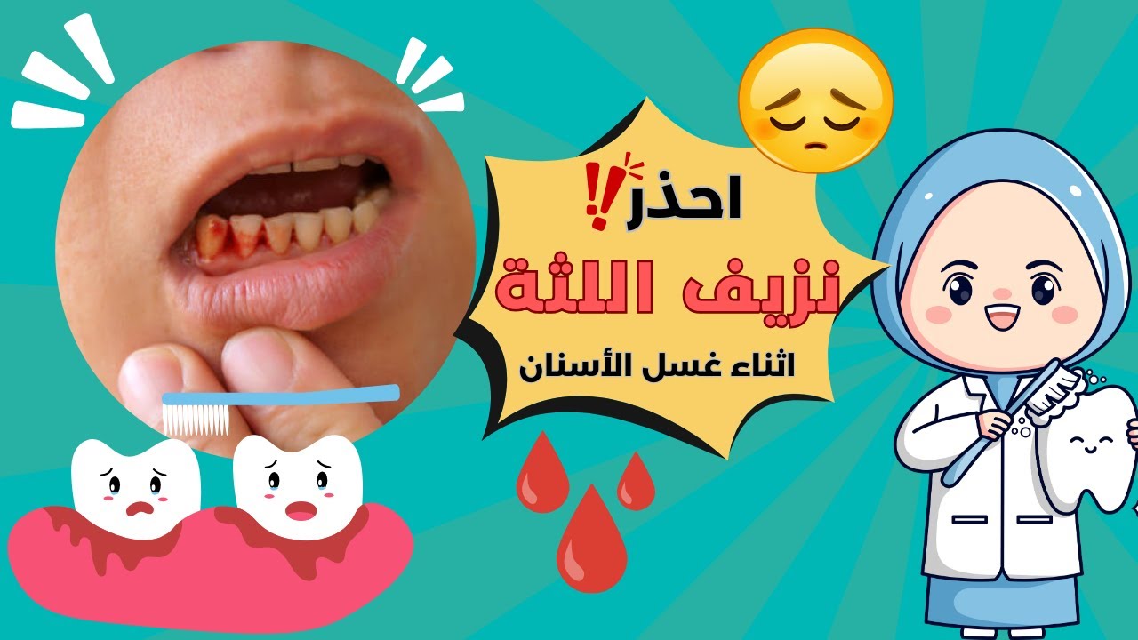 علاج الاسنان | احذر نزيف اللثة أثناء غسل الاسنان!! |حكاية أسناني.