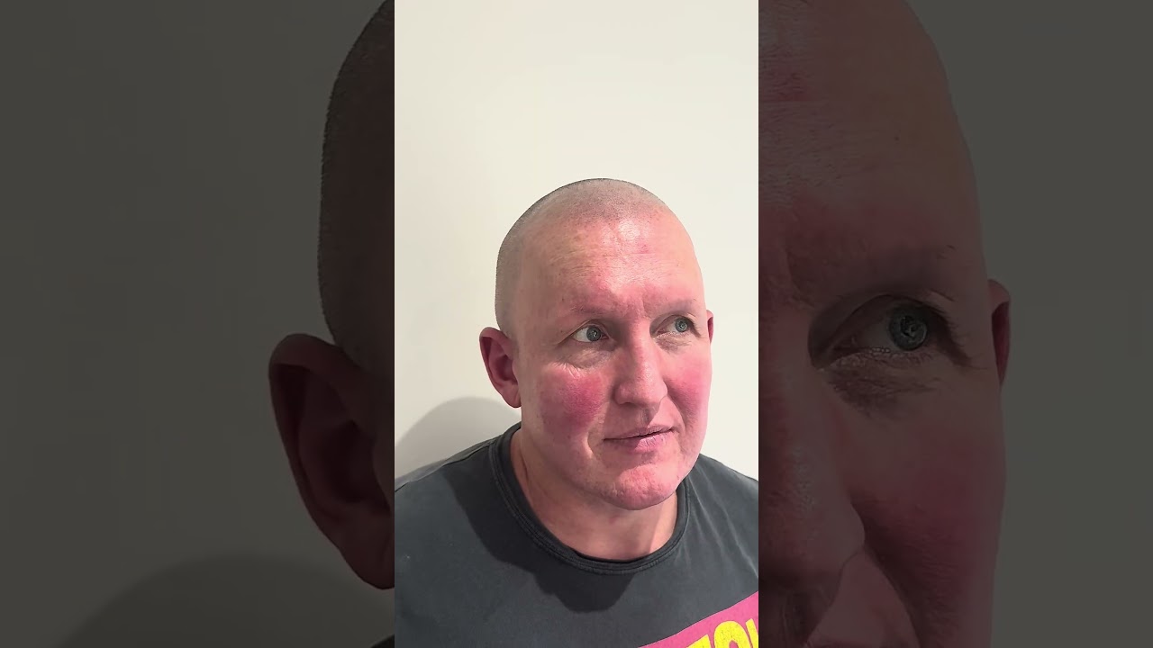 He Walked in Bald..and Left Looking 10 Years Younger 😱😍 | Scalp Micropigmentation UK Reveal