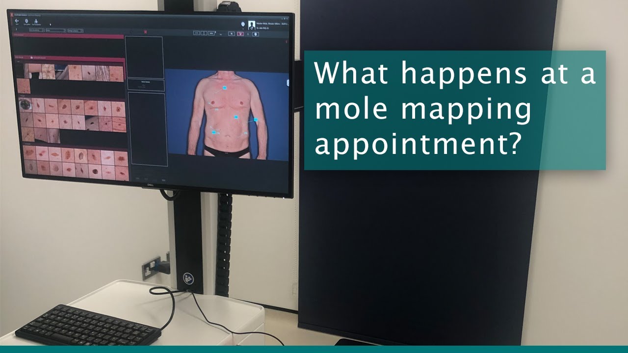 Mole Mapping Appointment Guide