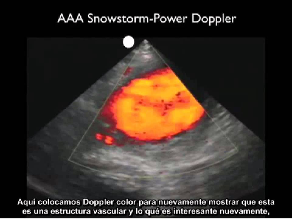 Procedimiento para realizar una ecografía de la aorta - Aneurisma