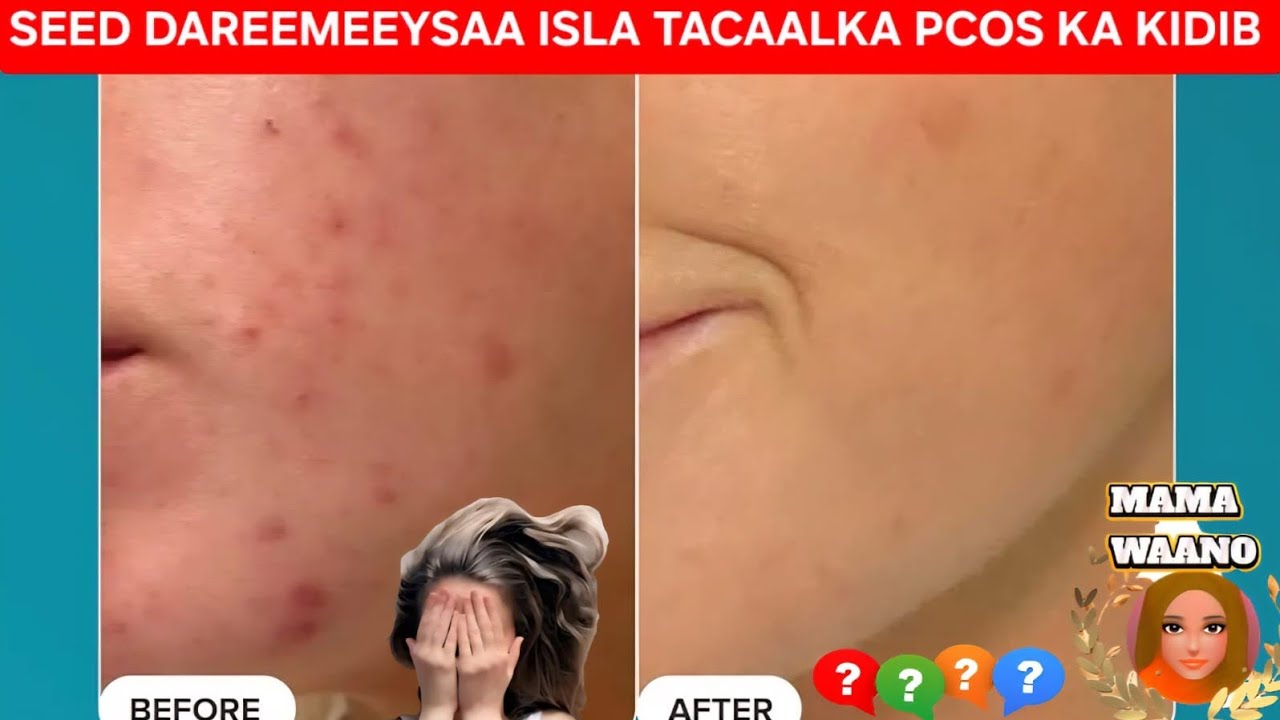 DHAQSI ISKALA TACAAL CILADAHA XANUUN EE MAKAANKA SIDA PCOS KA IYO FIBROID DA 