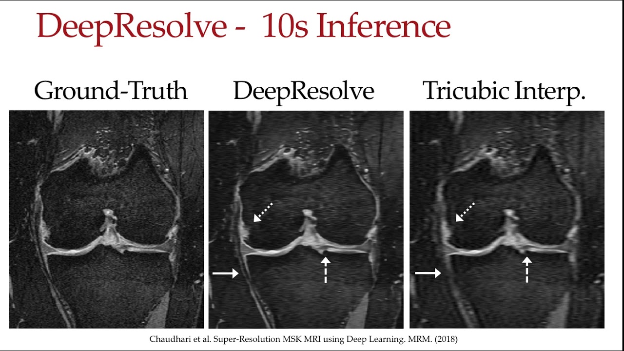 Akshay Chaudhari: Super-Resolution Musculoskeletal MRI using Deep Learning