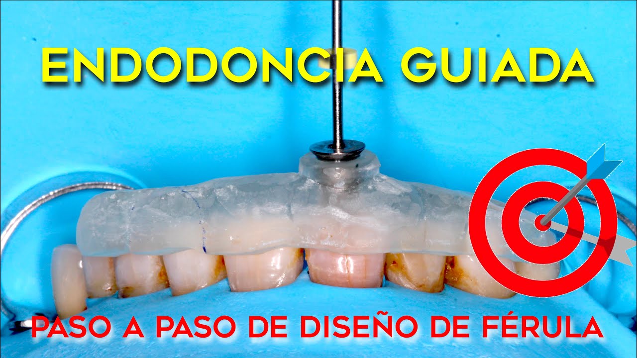 TUTORIAL ENDODONCIA GUIADA DIGITAL -  CÓMO DISEÑAR LA FÉRULA PASO A PASO EN DIENTES CALCIFICADOS