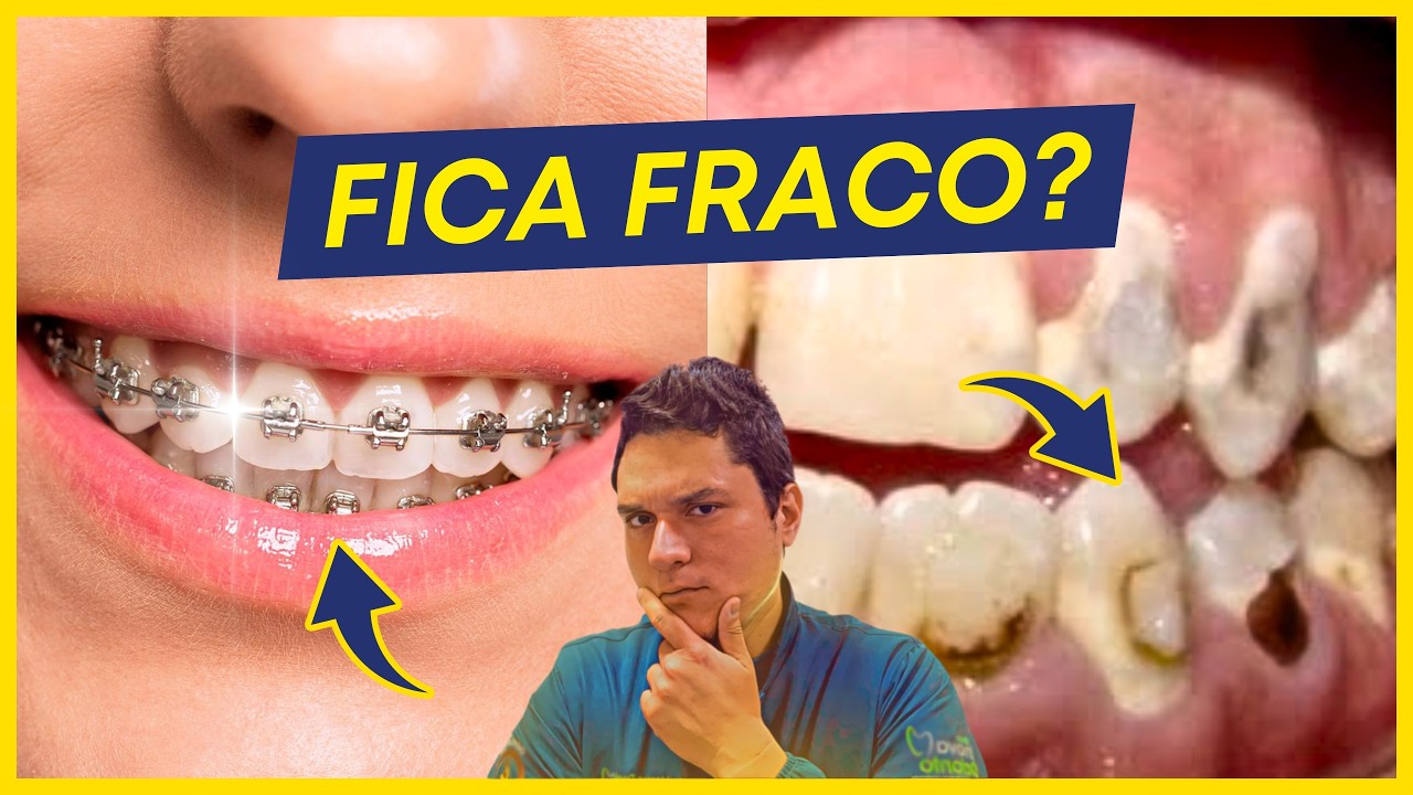 Aparelho deixa os dentes fracos? (A Verdade)