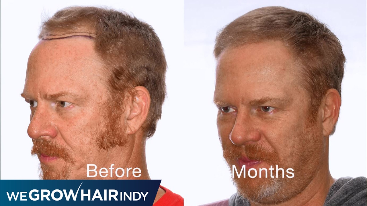 Amazing Hair Transplant after only 5 months - Q95's Gunner