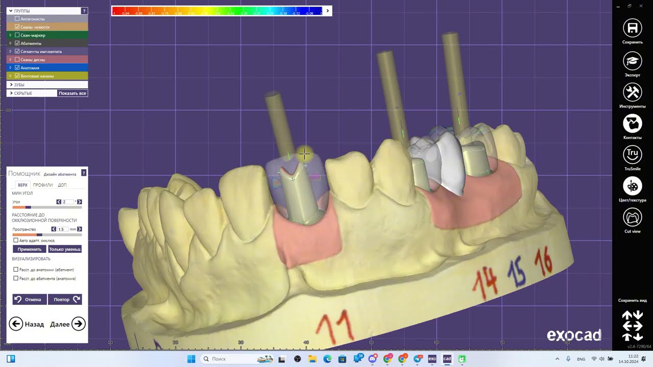 You Won't Believe How Easy EXOCAD Individual Abutment Makes Dental Work
