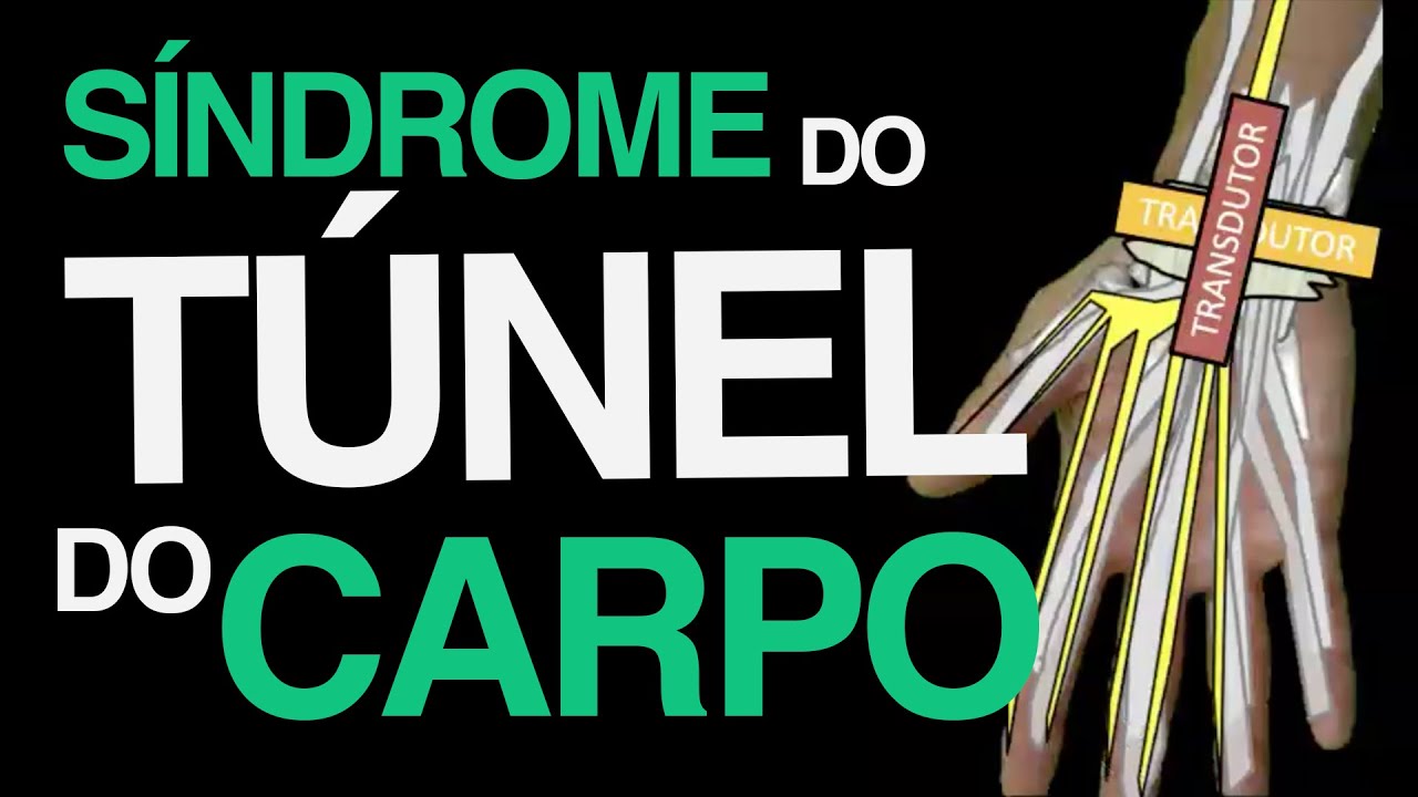 Síndrome do Túnel do Carpo (Passo a Passo)