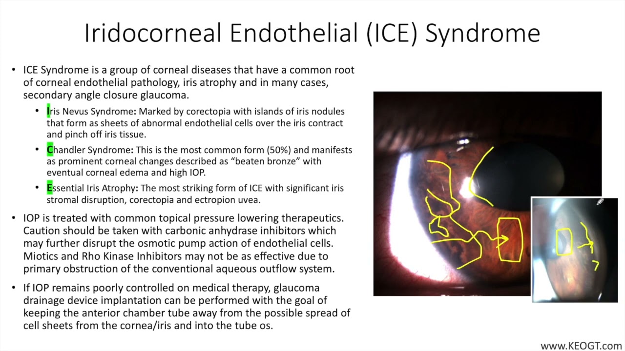 Lecture: Iridocorneal Endothelial (ICE) Syndrome (1 Slide in 5 Minutes)