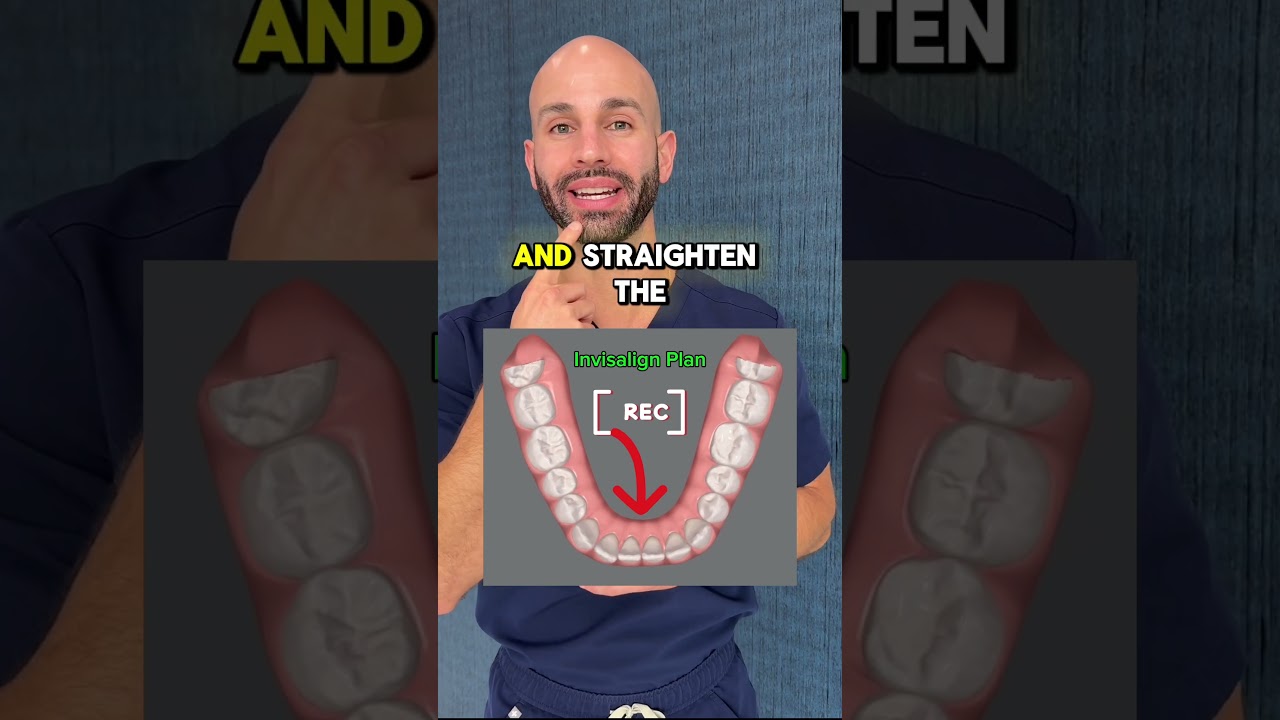 Teeth Crowding in Adults, and How We Fix it With Invisalign.