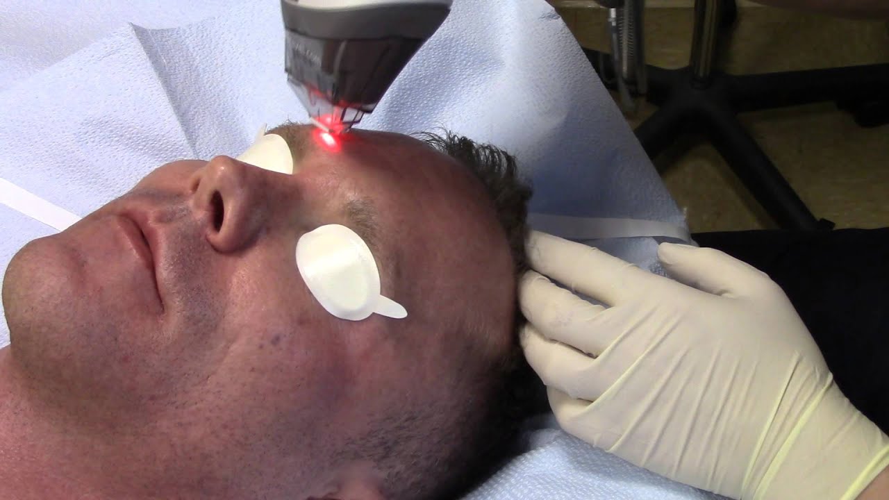 Fraxel DUAL Non-Ablative Laser For Facial Wrinkles, Sun Spots, Sun Damage (Age Prevention In a Male)