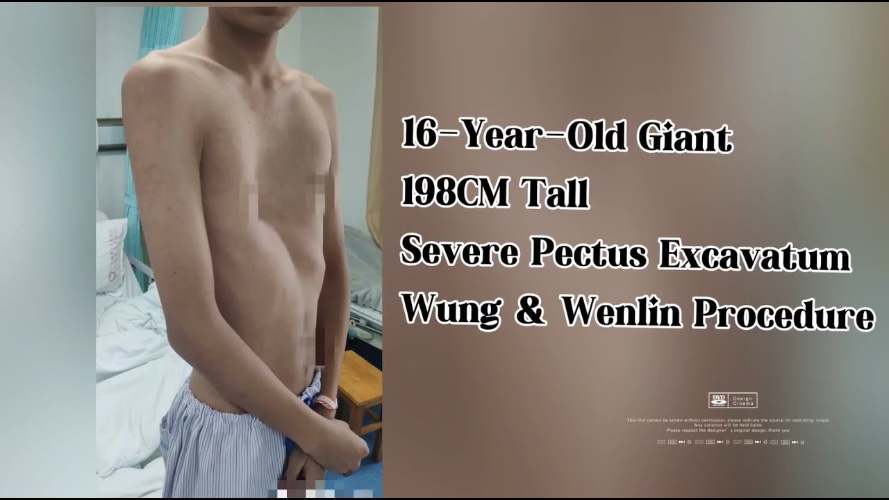 16 Year Old Giant,  Severe Pectus Excavatum, Wung & Wenlin Procedure