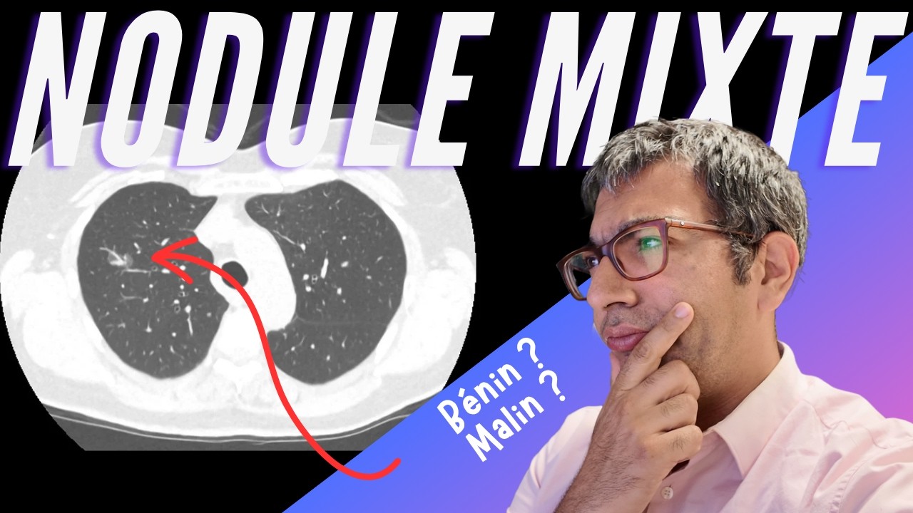Nodule mixte chez une ex-fumeuse : c’est bénin… ou c’est déjà trop tard ?