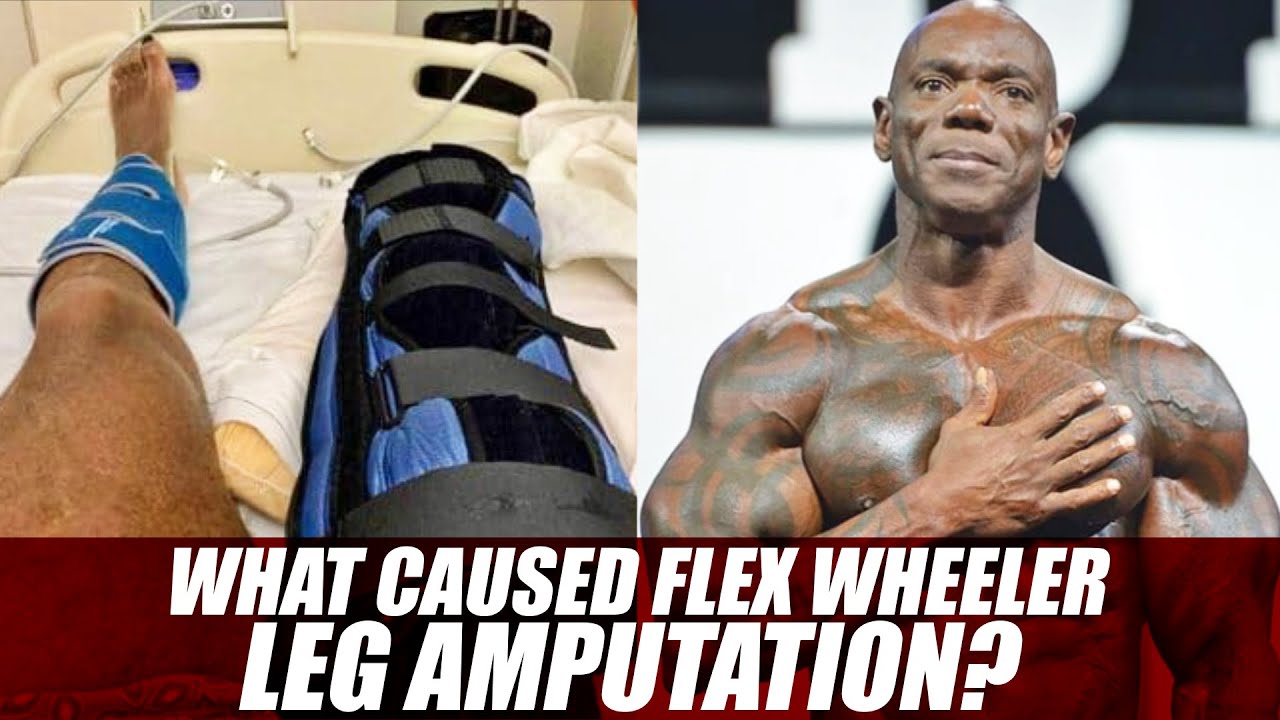 What Caused Flex Wheeler Leg Amputation?