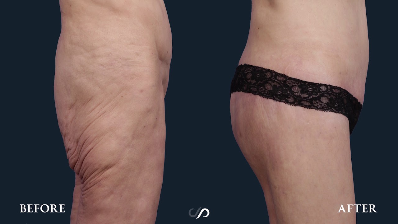INCREDIBLE BODY LIFT TRANSFORMATION | Before and after |Dr. David Stoker